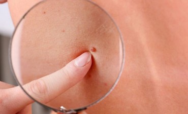 El Municipio se suma a la campa&ntilde;a nacional de prevenci&oacute;n de c&aacute;ncer de piel