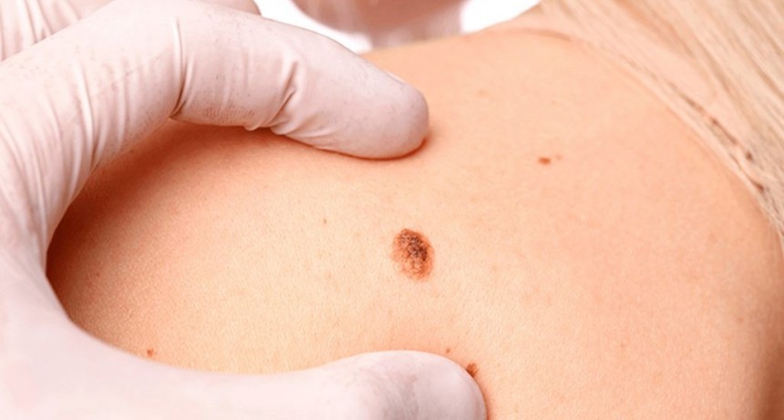 Prevenci&oacute;n del C&aacute;ncer de Piel: esta semana habr&aacute; controles gratuitos