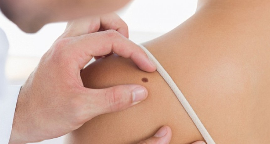 Para prevenir el cáncer de piel, se realizarán controles gratuitos